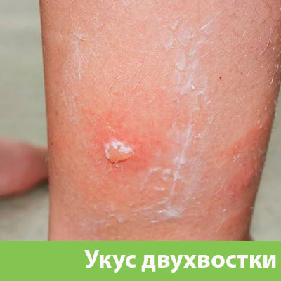 Укус двухвостки в Белорецке