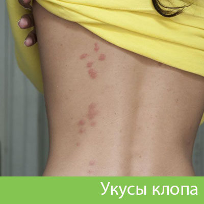 Профессиональное уничтожение клопов в Белорецке